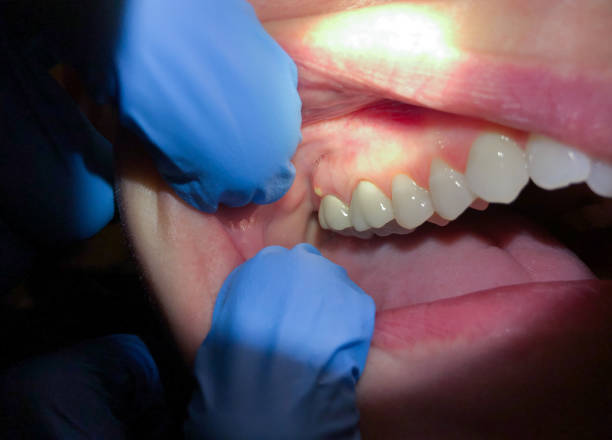 Best Emergency Dental Care for Sports Injuries in Mooresville, NC
