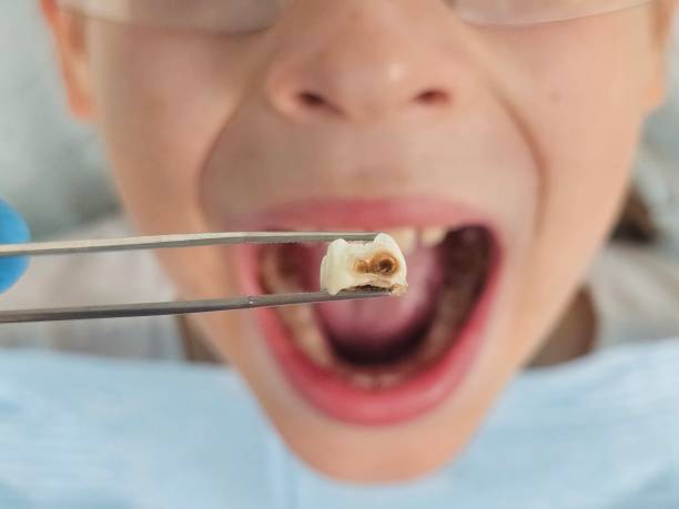 Best Emergency Wisdom Tooth Extraction in Mooresville, NC